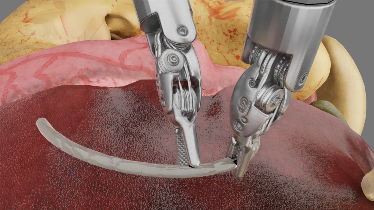 Digital surgery guidance