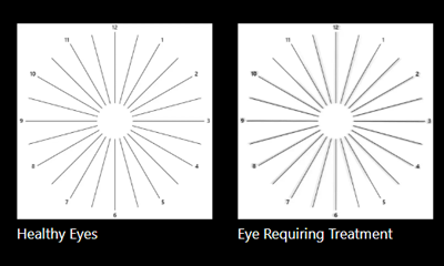 Astigmatism feature, providing eye advice.